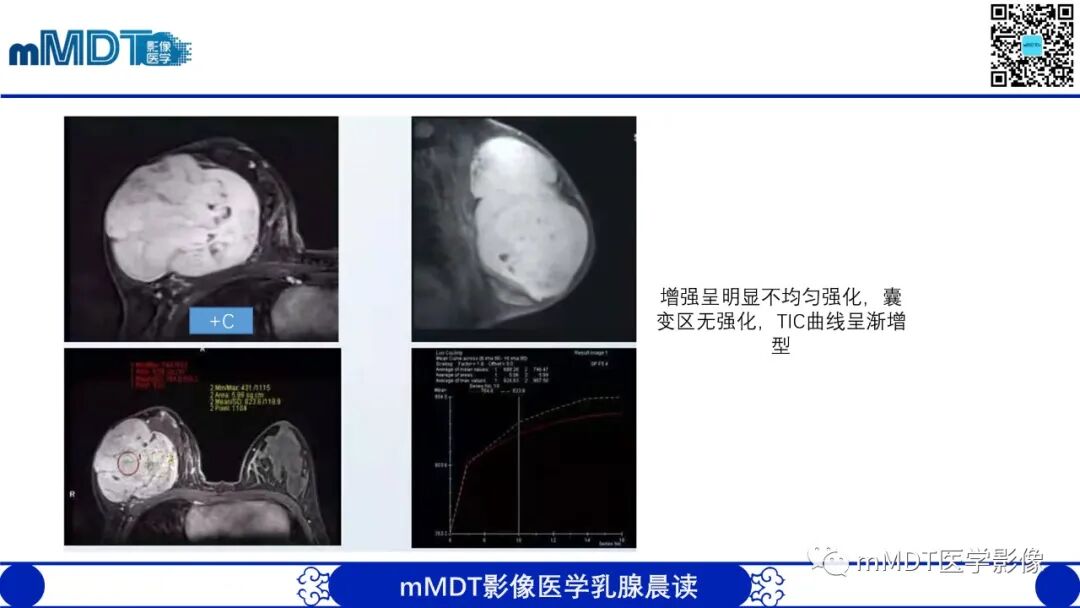 mmd在医学上什么意思乳腺叶状瘤病例分析--李凤陈_https://www.jmylbn.com_新闻资讯_第20张