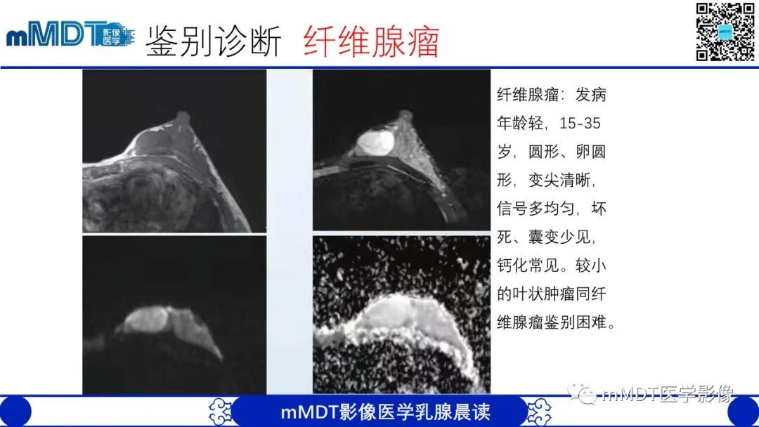 mmd在医学上什么意思乳腺叶状瘤病例分析--李凤陈_https://www.jmylbn.com_新闻资讯_第21张
