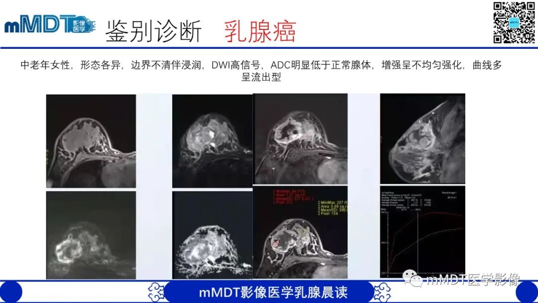 mmd在医学上什么意思乳腺叶状瘤病例分析--李凤陈_https://www.jmylbn.com_新闻资讯_第22张