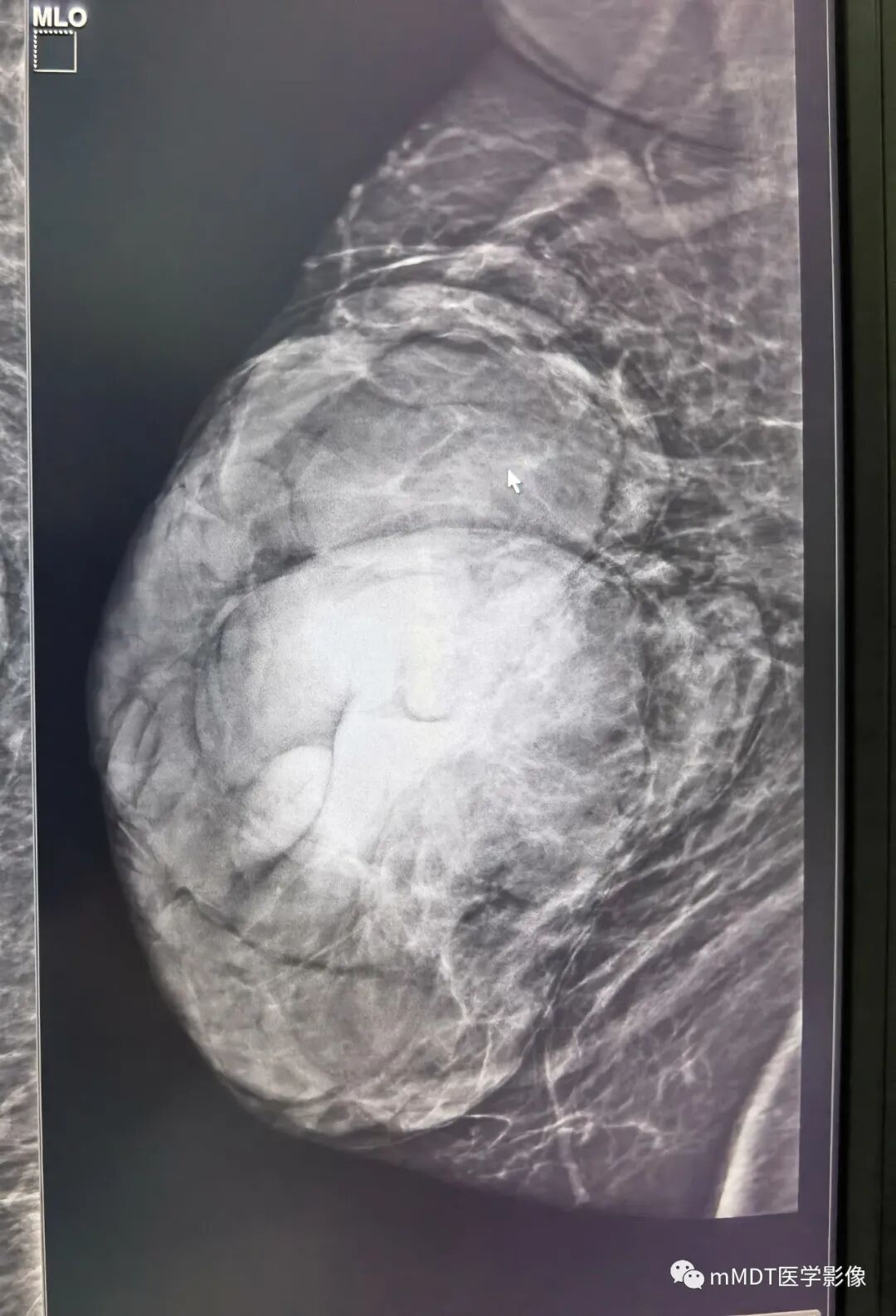 mmd在医学上什么意思乳腺叶状瘤病例分析--李凤陈_https://www.jmylbn.com_新闻资讯_第25张