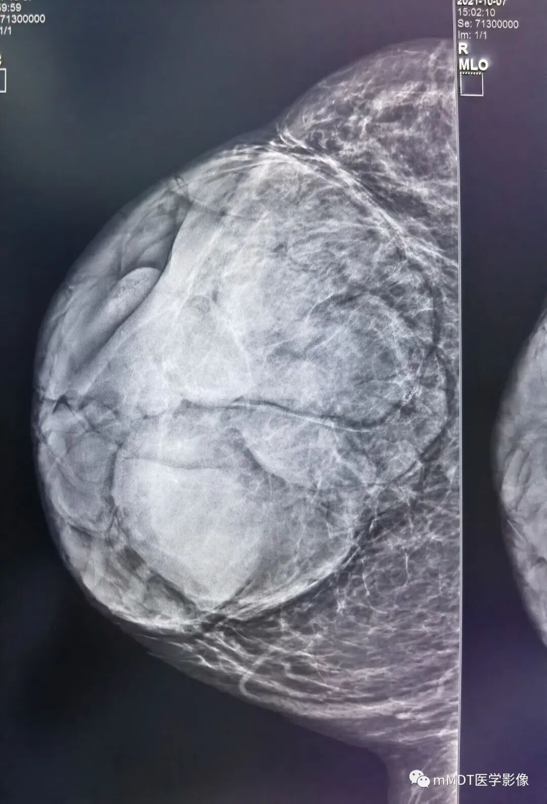 mmd在医学上什么意思乳腺叶状瘤病例分析--李凤陈_https://www.jmylbn.com_新闻资讯_第24张