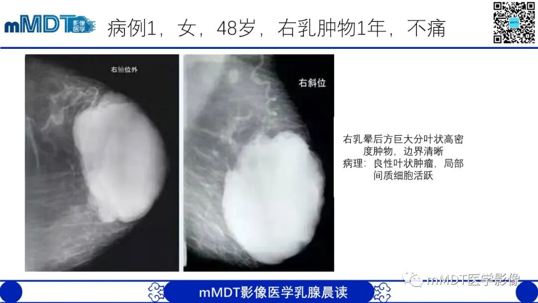 mmd在医学上什么意思乳腺叶状瘤病例分析--李凤陈_https://www.jmylbn.com_新闻资讯_第18张