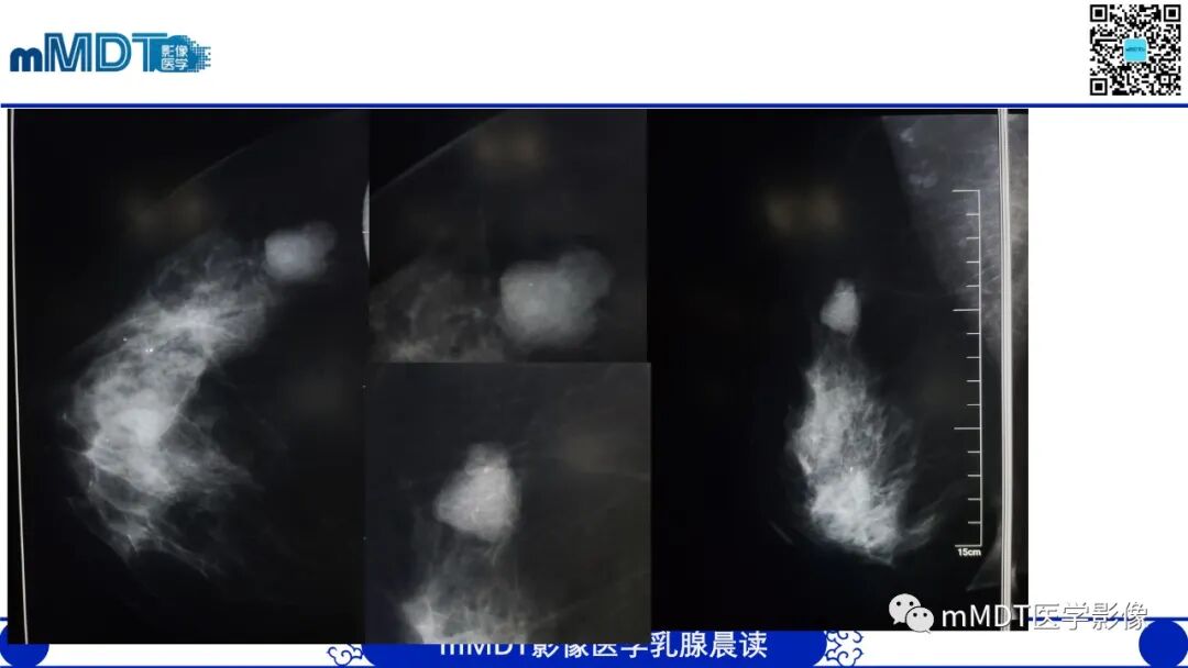 mmd在医学上什么意思乳腺叶状瘤病例分析--李凤陈_https://www.jmylbn.com_新闻资讯_第5张