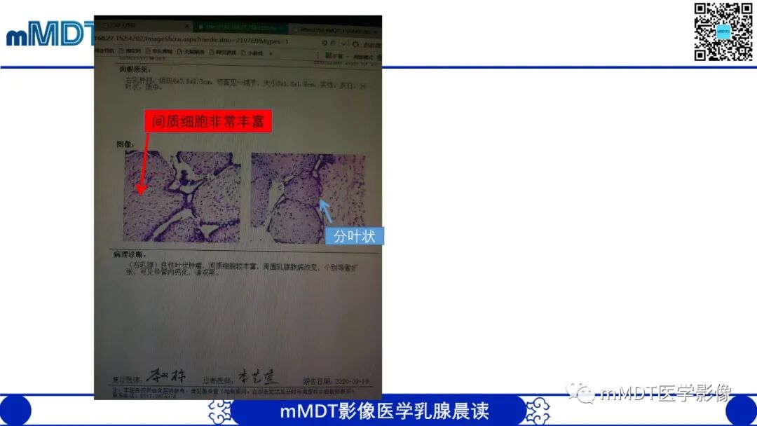 mmd在医学上什么意思乳腺叶状瘤病例分析--李凤陈_https://www.jmylbn.com_新闻资讯_第12张