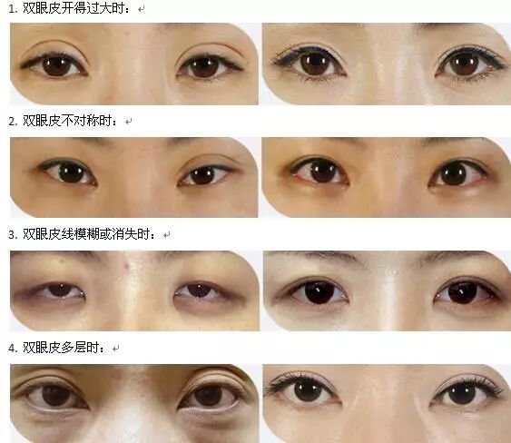 廊坊华康医疗美容整形失败后如何修复 蜜颜整形优惠