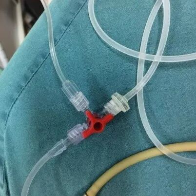 麻醉什么泵术后静脉镇痛泵（PCIA泵），您了解吗？_https://www.jmylbn.com_新闻资讯_第4张