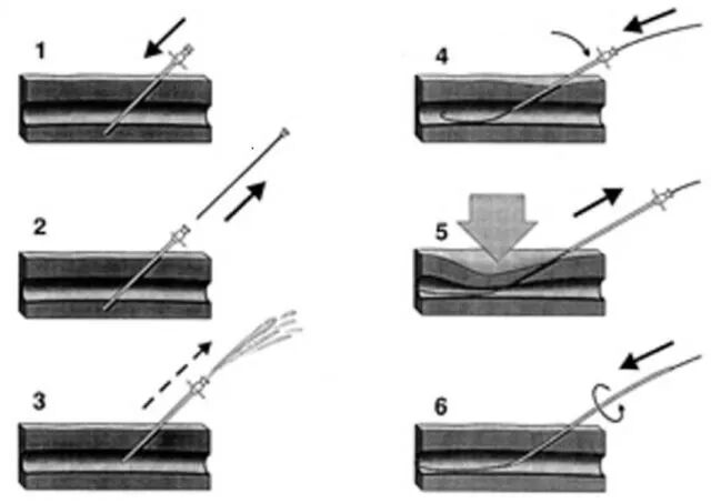 动脉长鞘怎么置入【经验分享】马志敏：条条入路通冠脉——动脉穿刺的这些知识你可能不知道！_https://www.jmylbn.com_新闻资讯_第5张