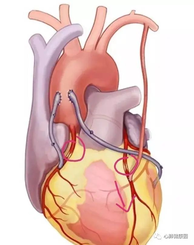 冠狀動脈旁路移植術中,搭橋所用的動脈或靜脈均來自患者自身(乳內動脈