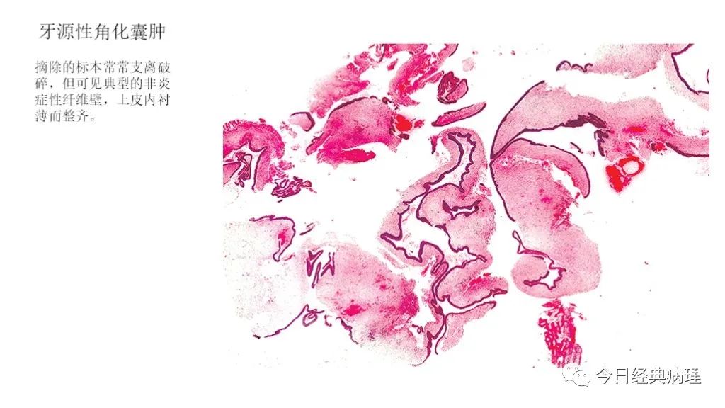 牙源性囊肿-八大囊肿