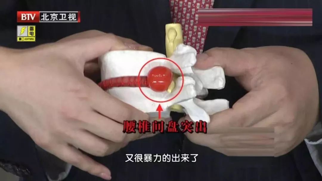 《柳葉刀》重磅：中國腰椎病患者已突破2億！該如何預防？ 健康 第2張