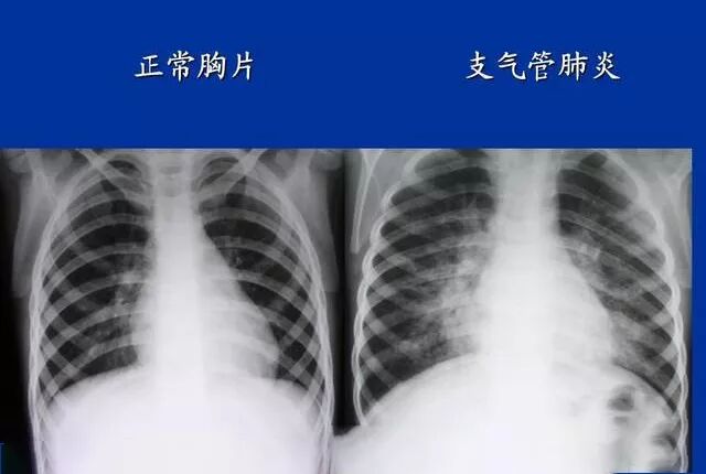 慢性支气管炎蔓延至支气管周围肺组织中就会发生支气管肺炎,这时患者