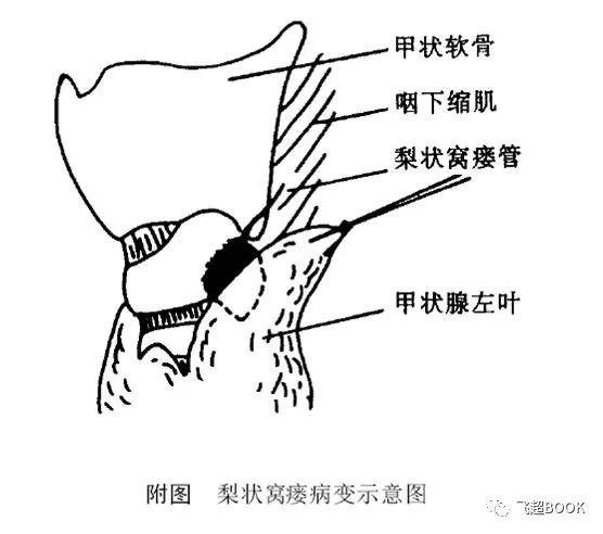 梨状窝解剖图图片