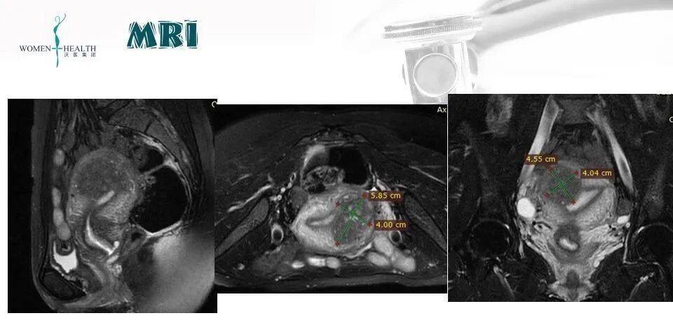 什么是无创缝合每周一手术丨龚晓明教授：宫腔镜曼月乐环缝合固定术_https://www.jmylbn.com_新闻资讯_第5张