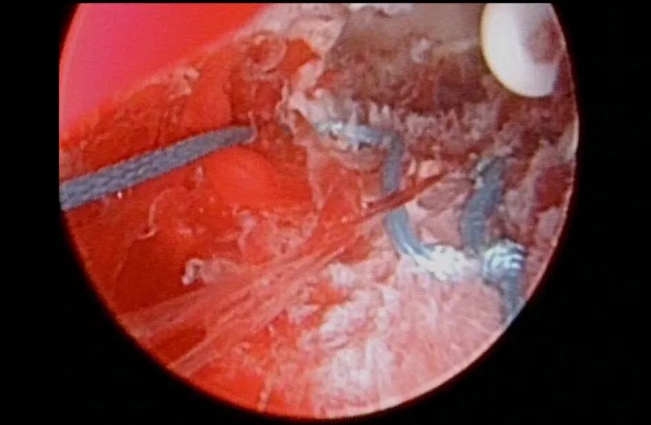 什么是无创缝合每周一手术丨龚晓明教授：宫腔镜曼月乐环缝合固定术_https://www.jmylbn.com_新闻资讯_第7张