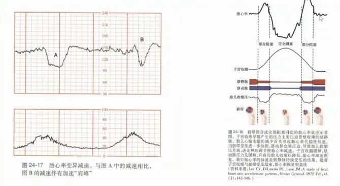 胎监cst是什么【温故知新】熟悉电子胎心监护判读要点，正确掌握胎监图纸解读六步法_https://www.jmylbn.com_新闻资讯_第30张