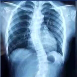 中小学生脊柱侧弯人数已超500万！这些不良习惯速改