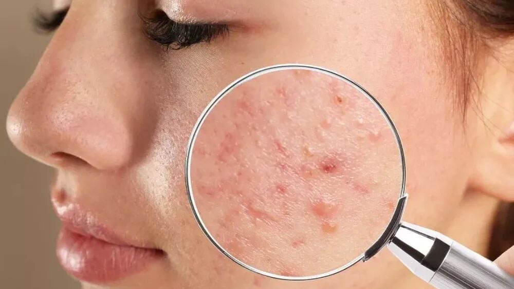 淡化痘印好的方法目前有效的是