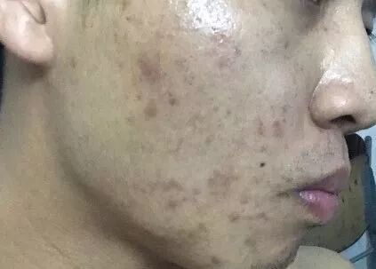 爆痘咋回事 护肤在西塘 微信公众号文章阅读 Wemp