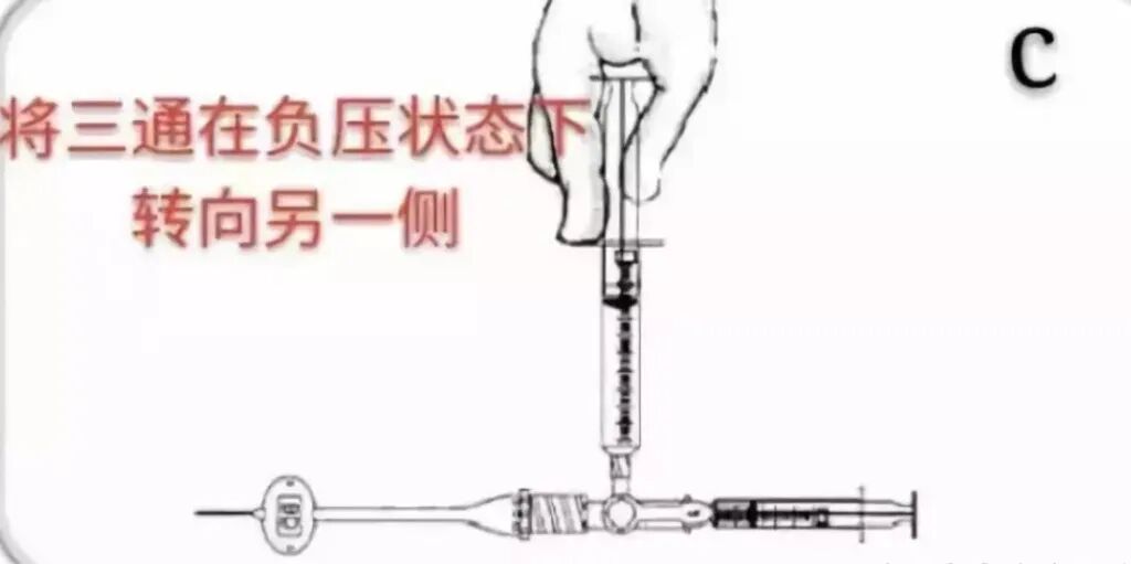 中心导管怎么使用中心静脉导管堵管的预防策略（附处理流程与操作视频）_https://www.jmylbn.com_新闻资讯_第12张