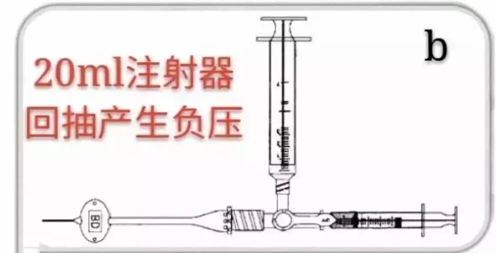中心导管怎么使用中心静脉导管堵管的预防策略（附处理流程与操作视频）_https://www.jmylbn.com_新闻资讯_第11张