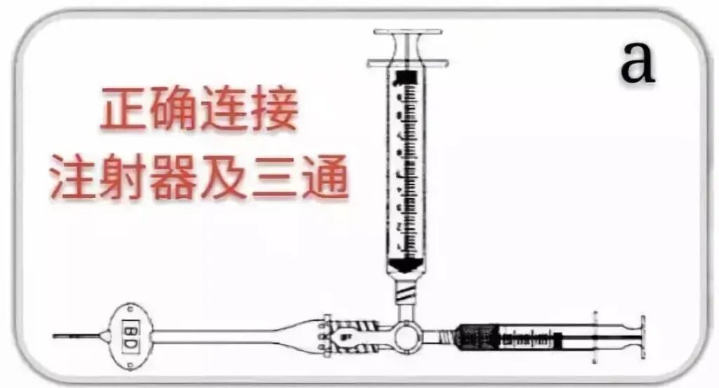 中心导管怎么使用中心静脉导管堵管的预防策略（附处理流程与操作视频）_https://www.jmylbn.com_新闻资讯_第10张