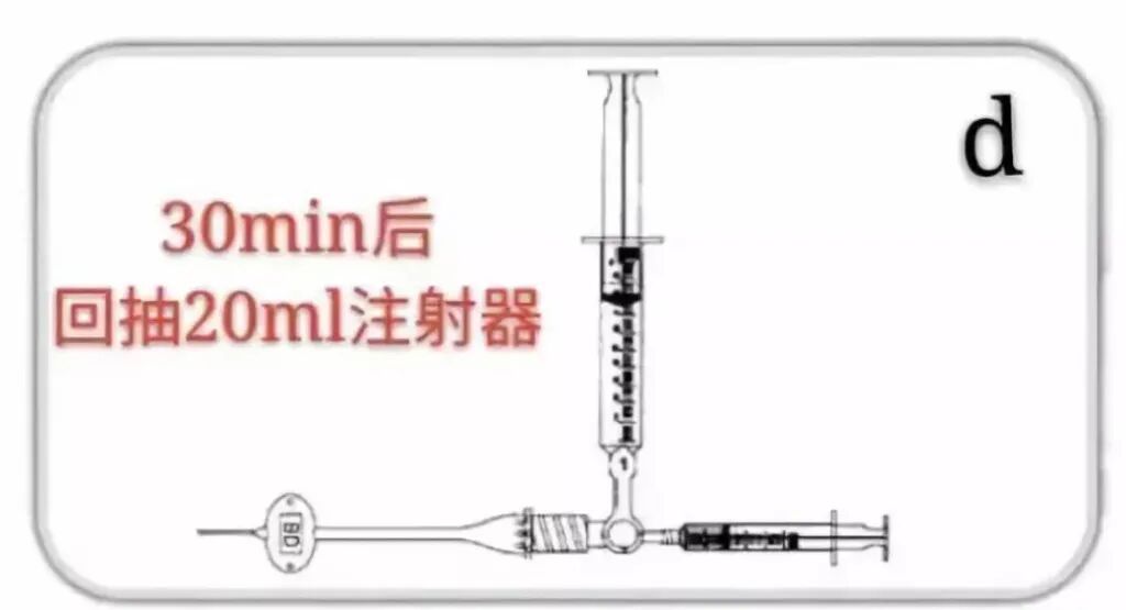 中心导管怎么使用中心静脉导管堵管的预防策略（附处理流程与操作视频）_https://www.jmylbn.com_新闻资讯_第13张