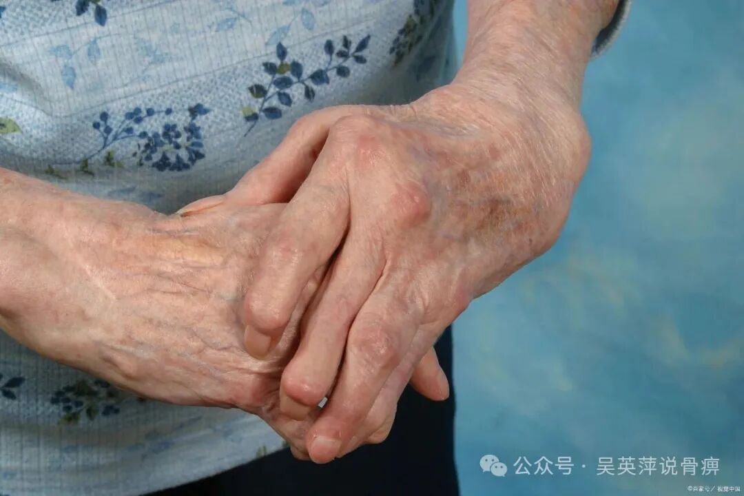 类风湿用好三味中成药