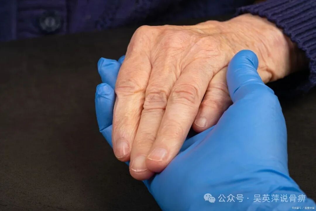 类风湿90%是脾虚一方中成药全改善
