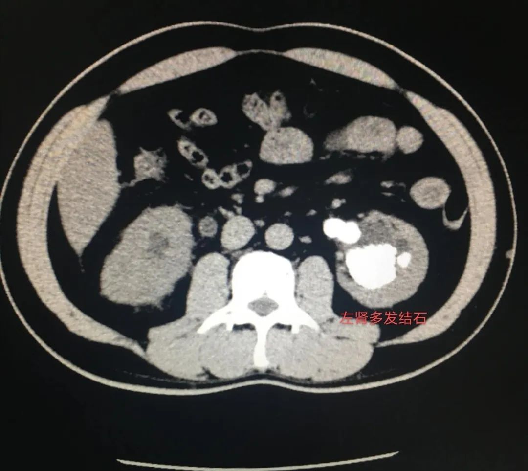 肾结石病历证明图片图片