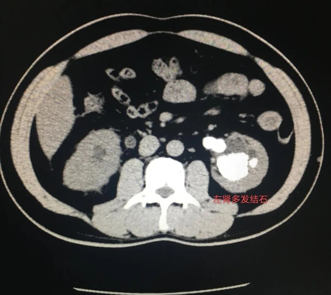 医生:肾结石无症状病人很多,严重可危及生命