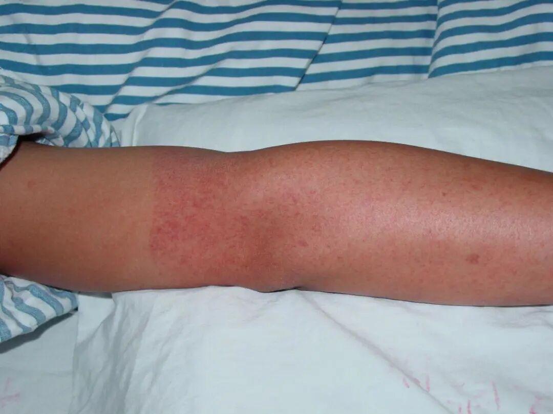 只有一部分患者感染登革热病毒后会出现临床症状