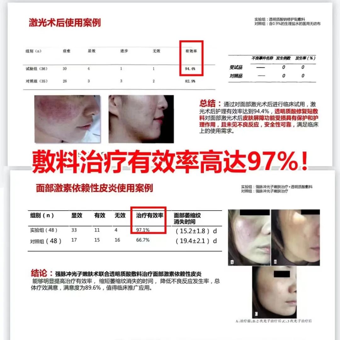6s加倍美为什么贵加倍美大型医院指定面膜 医用透明质酸皮肤修复敷料_https://www.jmylbn.com_新闻资讯_第3张