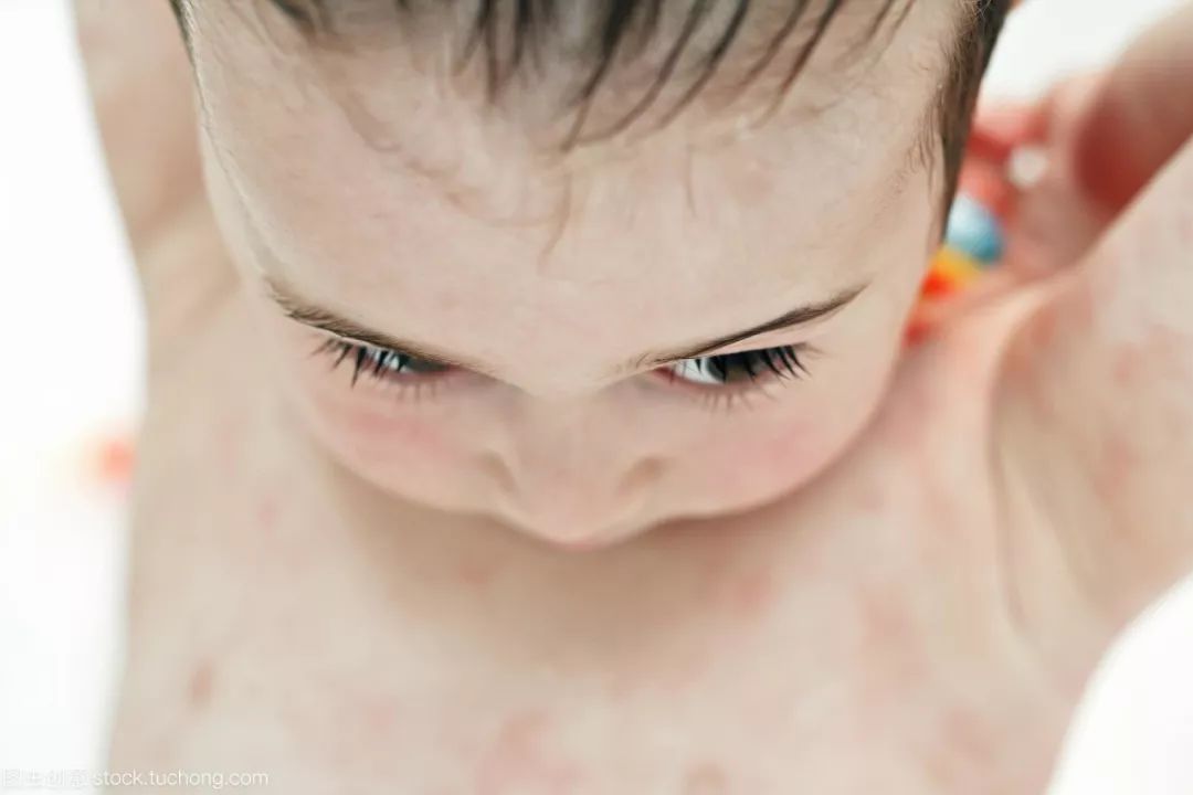 小兒濕疹（atopic dermatitis，AD） 健康 第4張