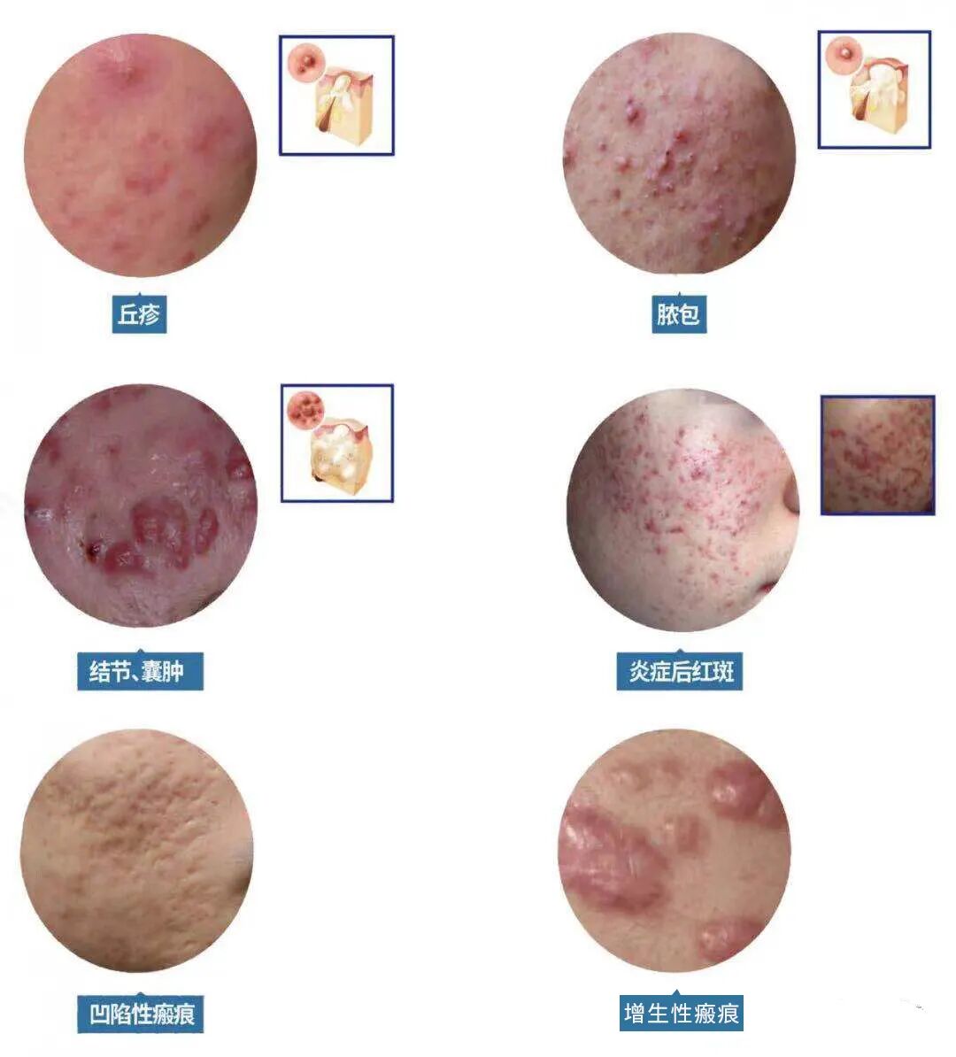 科普|关于痘痘的问题都在这里！