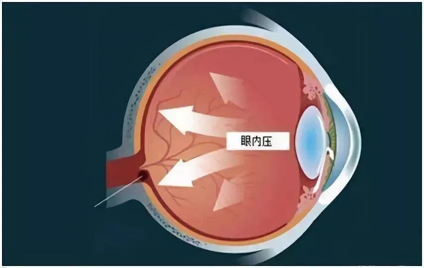 goldmann眼压计怎么读中央角膜厚度(CCT)对于眼内压的影响_https://www.jmylbn.com_新闻资讯_第1张