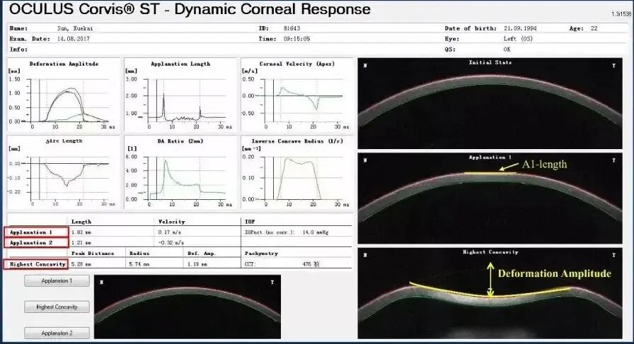 goldmann眼压计怎么读中央角膜厚度(CCT)对于眼内压的影响_https://www.jmylbn.com_新闻资讯_第4张