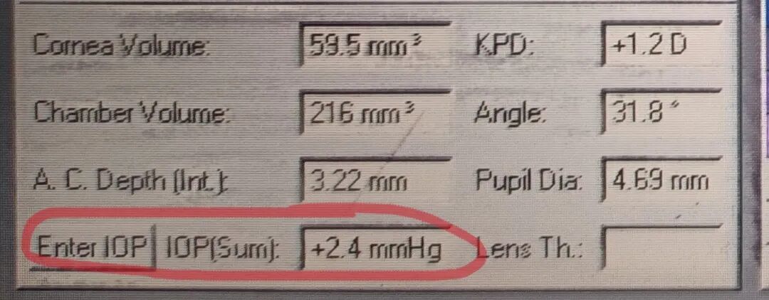 goldmann眼压计怎么读中央角膜厚度(CCT)对于眼内压的影响_https://www.jmylbn.com_新闻资讯_第3张
