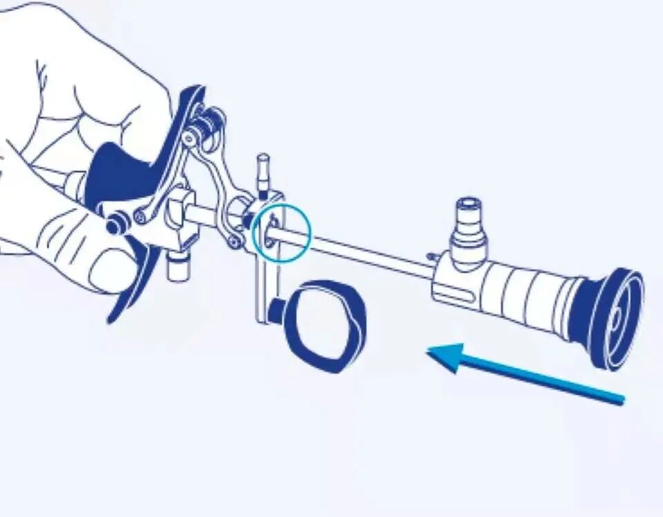 宫腔镜器械怎么组装手术器械介绍——宫腔镜组成与安装、种类与作用详解_https://www.jmylbn.com_新闻资讯_第8张