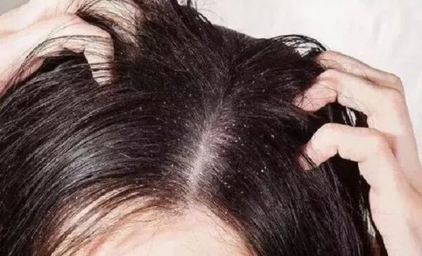 头顶经常出油是什么原因呢？