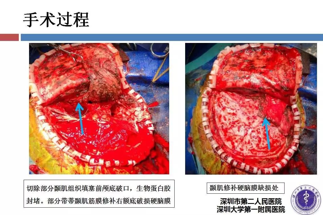 钢筋致穿透性颅脑损伤病例分享一例丨颅脑创伤神经重症病例周刊第27期