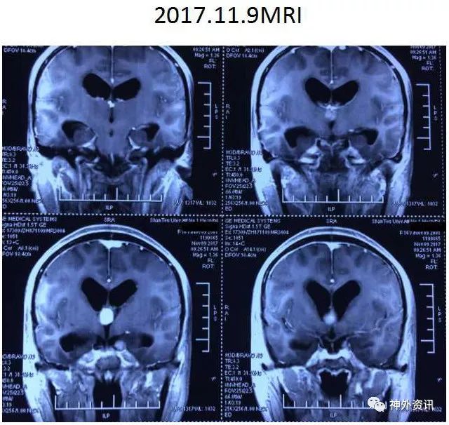 张晓彪教授团队神经内镜垂体腺瘤切除术经endoport三脑室肿瘤切除术