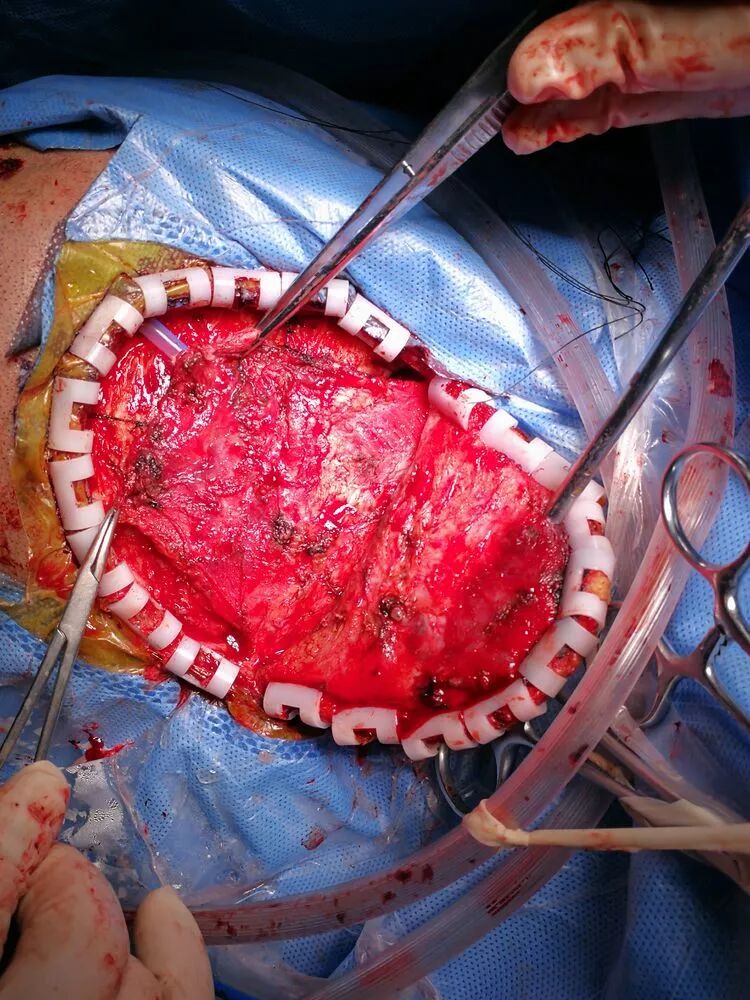 病例分享一例重度脑干出血的外科手术治疗