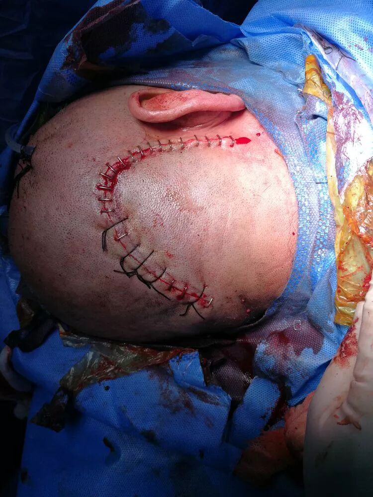 病例分享一例重度脑干出血的外科手术治疗