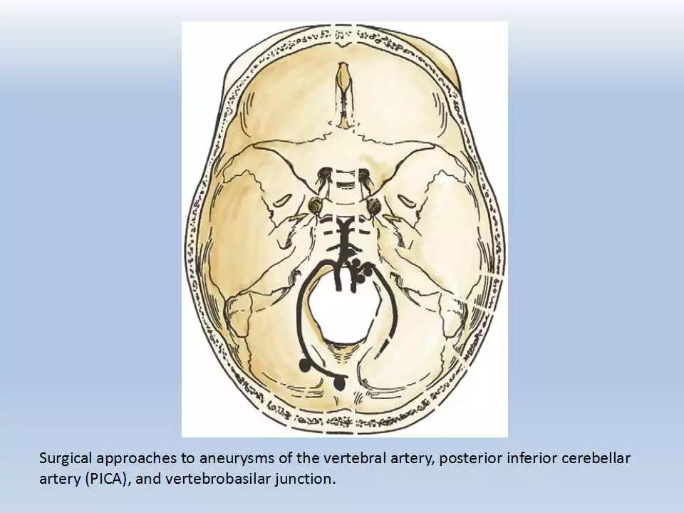 颅内动脉瘤经典文献二