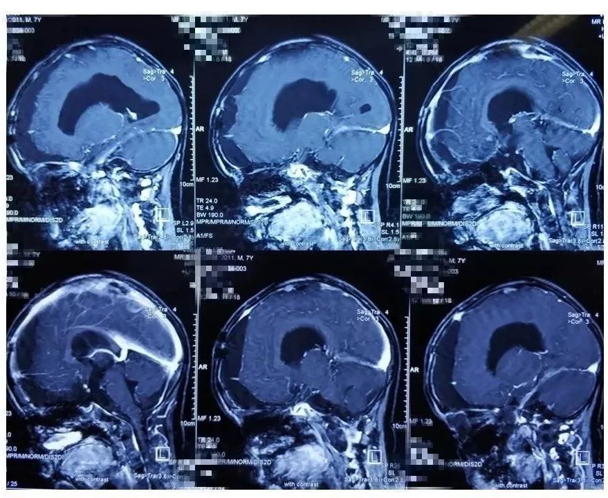 步星耀教授團隊鞍區鞍旁三腦室斜坡巨大顱咽管瘤切除病例分享