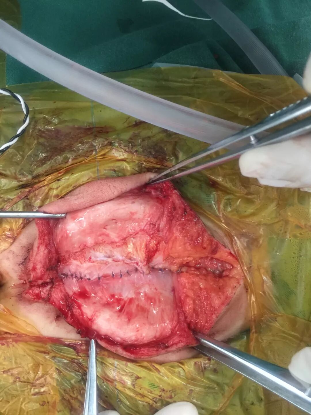 王杭州主任脊柱裂治疗新理念探索