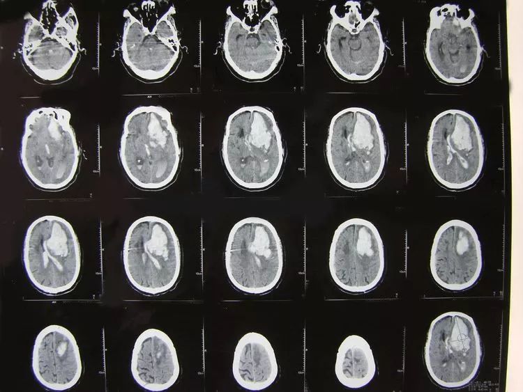 现分享几例患者的ct片如下