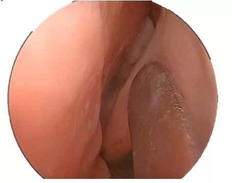 【耳鼻喉鏡篇】內鏡下經鼻蝶入路切除顱咽管瘤 【耳鼻喉鏡篇】內鏡下經鼻蝶入路切除顱咽管瘤