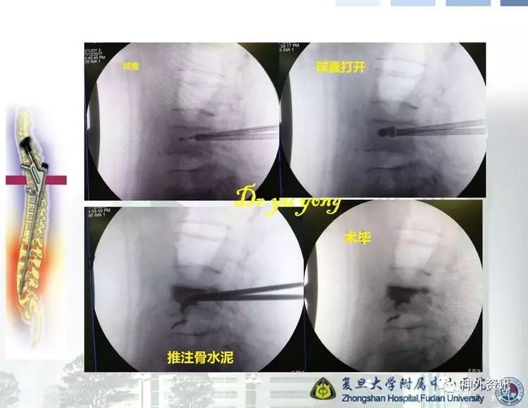 這裡簡單科普一下,骨質疏鬆引起的壓縮性骨折多見於老年女性.