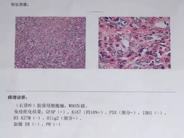 基因時間∣經典案例母子皆安基因檢測指導妊娠期膠質母細胞瘤braf靶向